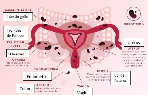 Endometriose.png