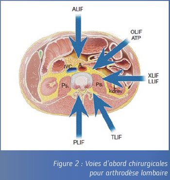 Figure 2 : Voies d'abord chirurgicales pour arthrodèse lombaire