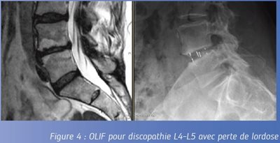 Figure 4 : OLIF pour discopathie L4-L5 avec perte de lordose